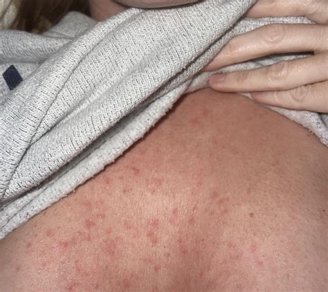 Hives Post Pregnancy