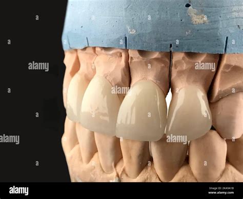 White front teeth veneers on diagnostic model on dark background. Implants of the jaw of a ...