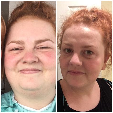 Top 105+ Pictures Cushing's Syndrome Cushing's Disease Before And After Photos Latest