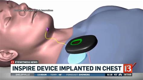 New sleep apnea treatment considered top 2018 innovation, available in Indiana | wthr.com