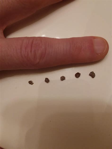 4mm Kidney Stone started its journey. 2 other non obstructing found. 21yo Male. : r/KidneyStones