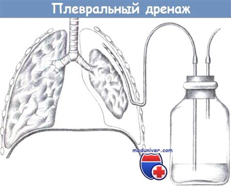 Виды и применение дренажей в хирургии