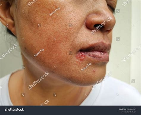 Herpes Rash On Face 13 Pictures Of Common Skin Rashes