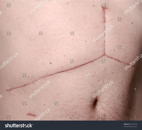 Liver Transplant Scar Stock Photo 23016979 : Shutterstock