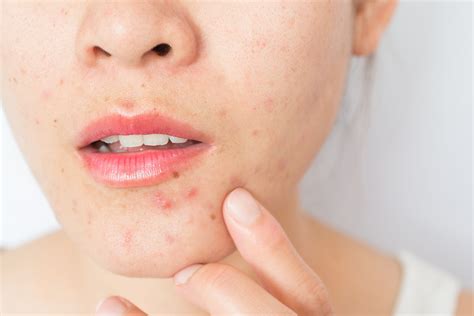 What Is Period Acne & How To Get Rid Of It - WOW 360