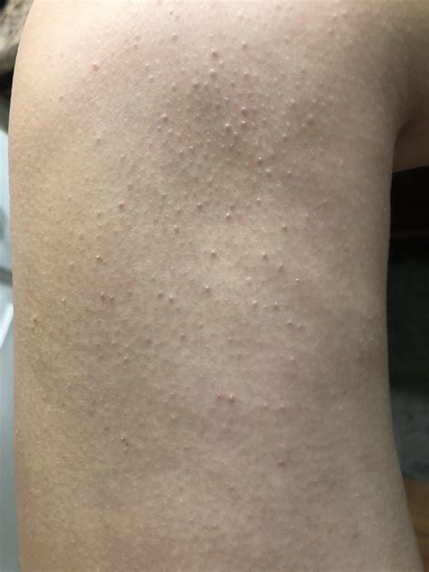 White Raised Bumps On Back Milia (Milk Spots): Causes & Treatment