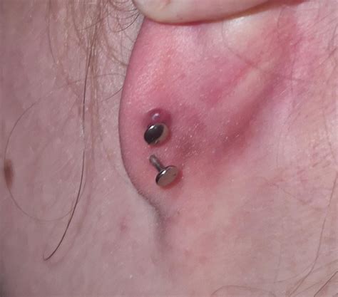 Keloid or irritation bump? : r/piercing