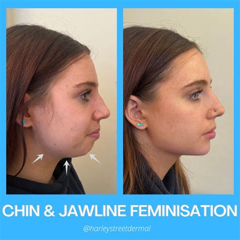Jawline Filler Everything You Need To Know About Chin Filler