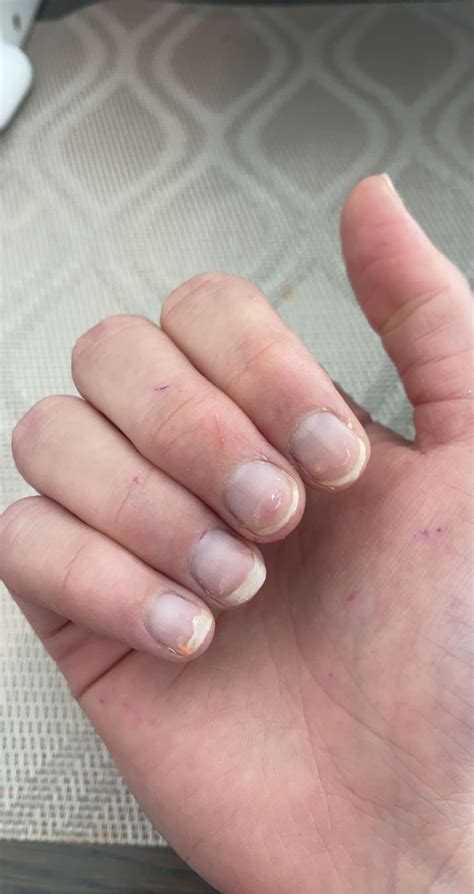 Poor circulation or Raynaud’s? My feet & toes turn purple/red when I am sitting or standing ...