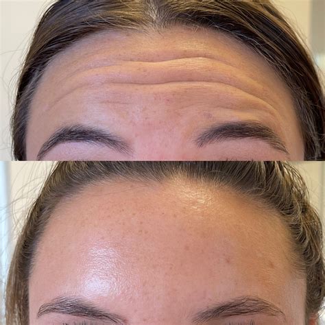 Before & Afters — Beverly Botox Nurse