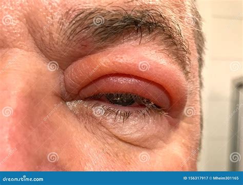 Upper Eyelid Infection - Chalazion Stock Photo | CartoonDealer.com #135835416