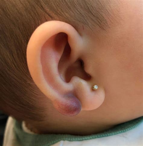An infant with a tender bump on her ear | MDedge Family Medicine