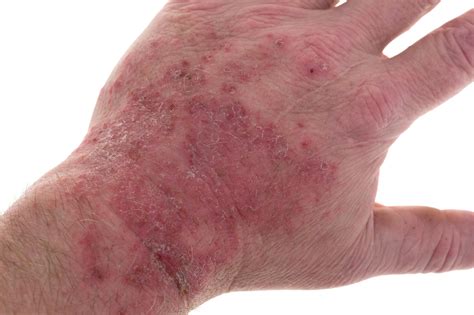 Different Types of Eczema: How to Identify and Treat Them