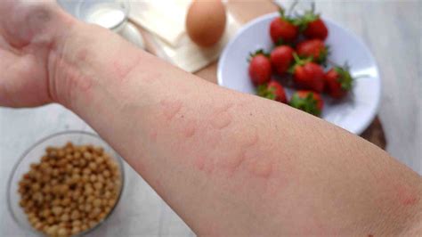 8 πράγματα που πρέπει να γνωρίζουμε για τις τροφικές αλλεργίες ...