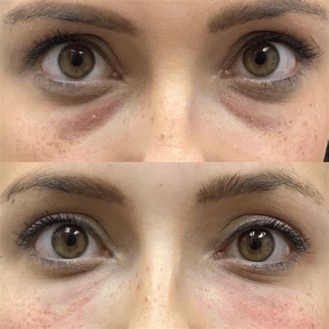 Martins Treatments - PRP Under Eye Dark Circle Repair