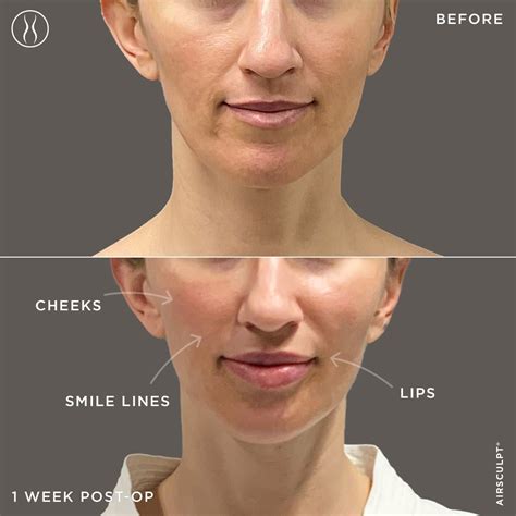 Achieving Fuller Lips: The Ultimate Guide to Lip Augmentation | AirSculpt