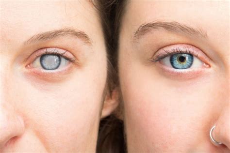 Как вылечить катаракту в домашних условиях? | MedAboutMe