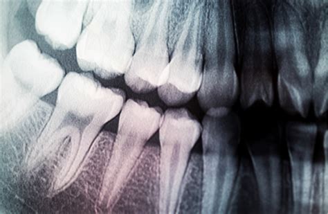 Is It Safe To Xray Teeth