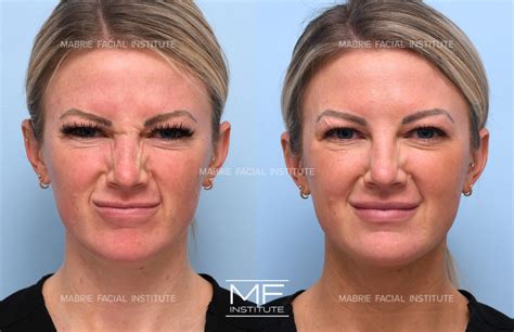 Nose Filler & Nose BOTOX in the San Francisco Bay Area | Mabrie Facial ...