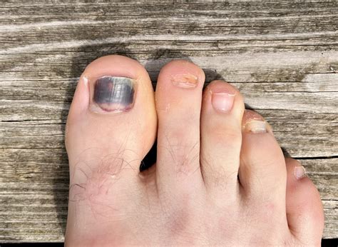 Infected Toenail Images