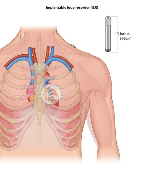 Loop Implant Explant – Dr. Hari Sugumar | Electrophysiologist & Cardiologist