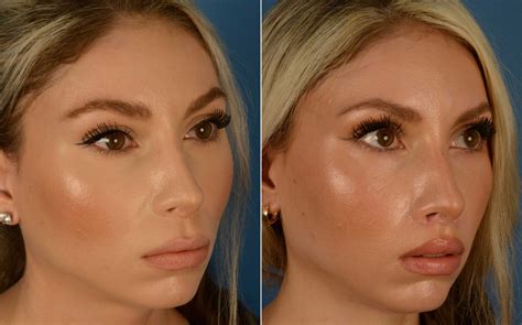 Dental Lip Lift at Isla Lascelles blog