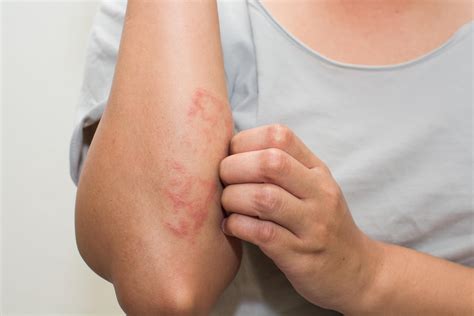Eccema | Dermatitis | Dermatitis atópica | MedlinePlus en español