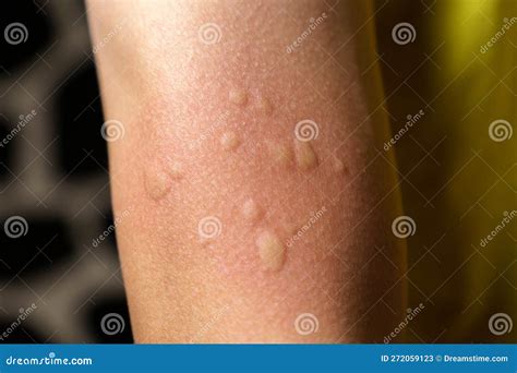 Allergy Symptoms, after Injection. Edematous Part, Red Puncture Site ...