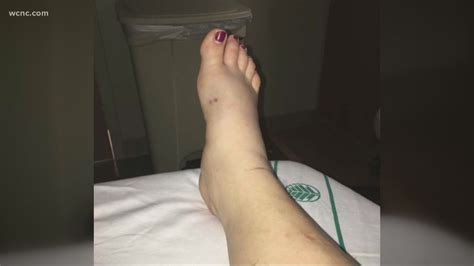 Local woman recovering after venomous snake bite | wcnc.com