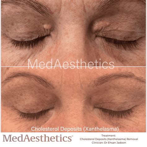 Xanthelasma Removal At Home Cholesterol Control Xanthelasma Treatment: