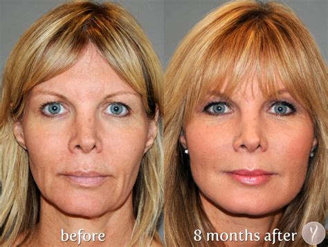 The Y Lift Face Lift Procedure. phoenix skin Y lift before and after Y Lift_phxskin_4 | Face ...