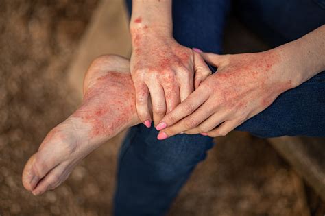 Mediterranean diet supercharges skin treatment, clears up atopic dermatitis in teen - THE CARE NEWS