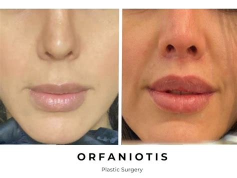 Remove Scars On Lips | Lipstutorial.org