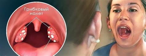 Fungus in the throat - what is it, symptoms, treatment and prevention ...