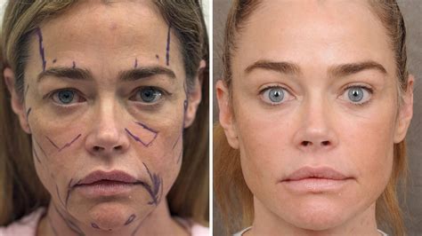 Denise Richards' Raw Facelift Before-and-After Photos Are the ...