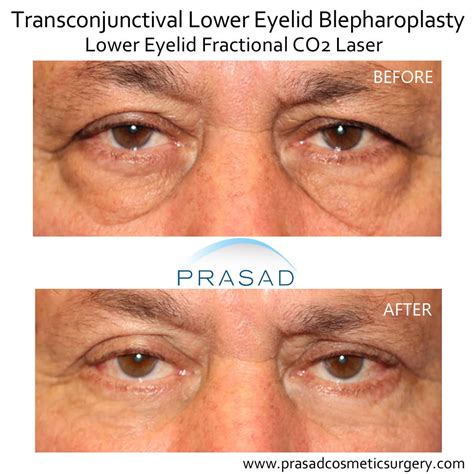 Lower Blepharoplasty Before and After Photos