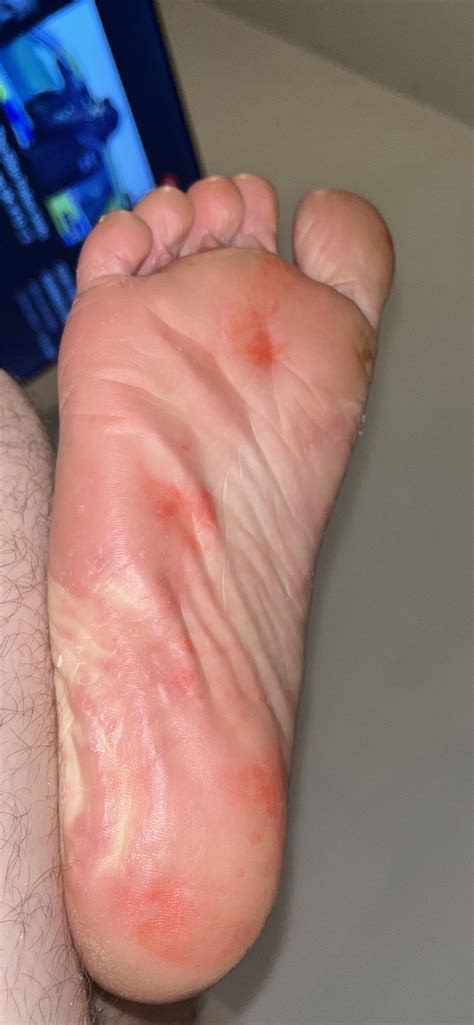 Painful Red Spots On Heel Of Foot Factory Sale | emergencydentistry.com
