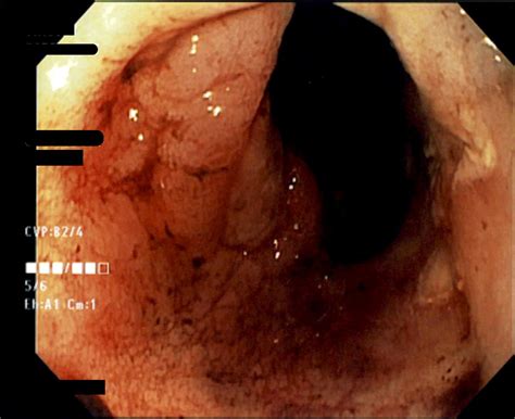 Dieulafoy’s Lesion In The Oesophagus: A Rare Cause Of Upper ...