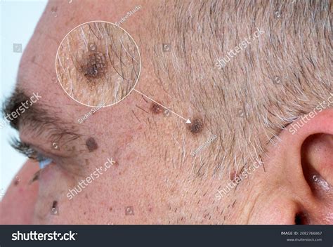 Dark Spot On Face Cancer