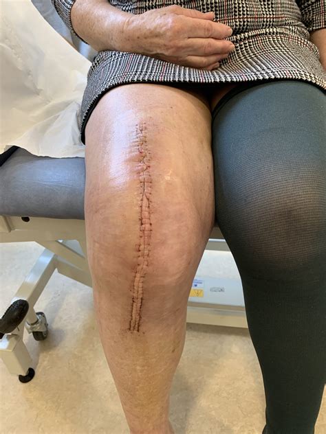 Shoulder Impingement Treatment Worcestershire