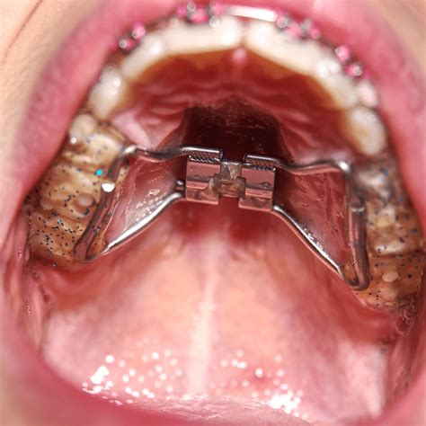 Invisalign Palatal Expanders for Teens: A Discreet and Effective Orthodontic Option - The Teal ...