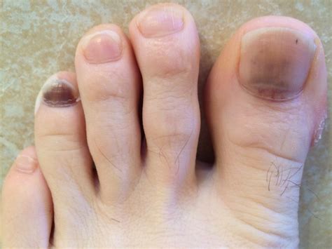 What Does A Bruise Under The Toenail Mean at Odessa Francis blog