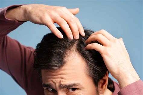 Understanding the Timeline: Hair Regrowth Progress with Finasteride