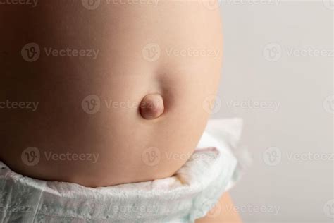 Umbilical hernia in newborns on the stomach, close-up. Treatment of ...