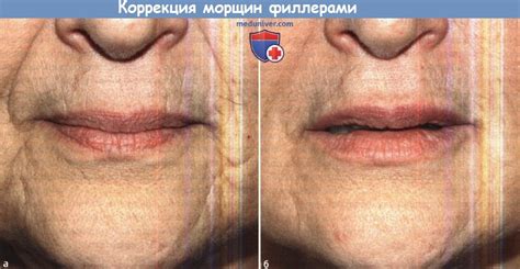 Методика применения филлеров для коррекции морщин
