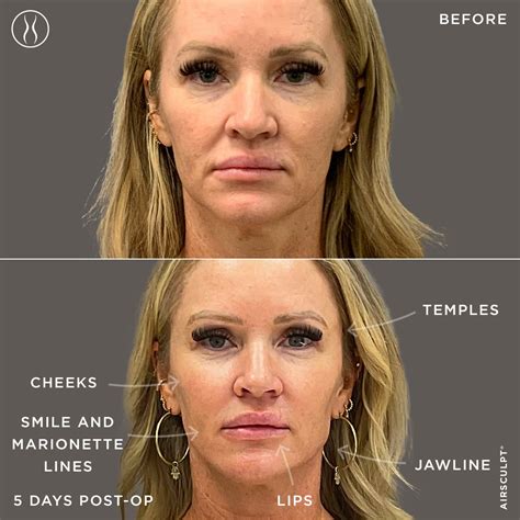 Fat Transfer To Lips