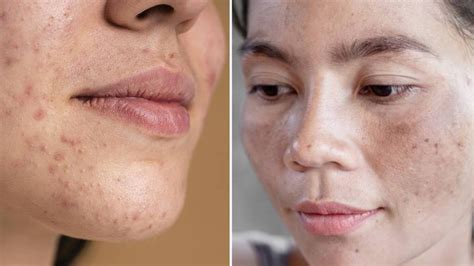 Da xỉn màu là gì? Nguyên nhân và cách làm sáng da bị xỉn màu
