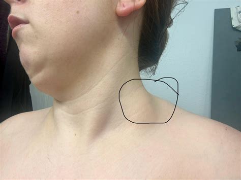 Swollen lymph node on right side of neck : r/medical
