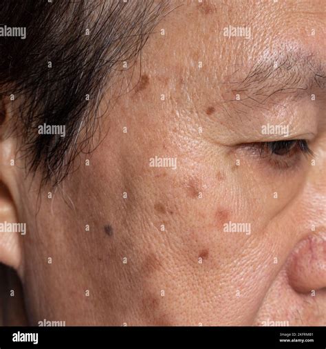 Small brown patches called age spots on face of Asian elder man. They are also called liver ...