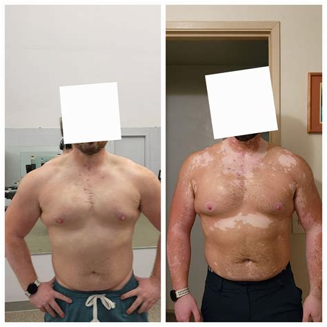 187 best r/melanotan2 images on Pholder | 4-5 month results